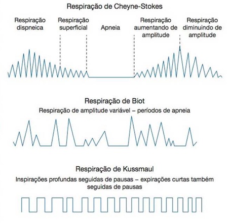 O que é a respiração de Kussmaul?